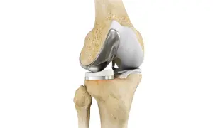 Protesi ginocchio: immagine anatomica di un ginocchio con impianto protesico. Utile per chi soffre di dolore notturno.