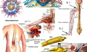 Illustrazione di compressione nervosa, virus erpetico e mielina danneggiata, con sintomi di nervo lesionato.