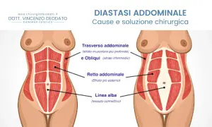 Illustrazione anatomica che mostra la diastasi addominale, evidenziando i muscoli retti e obliqui e la linea alba.
