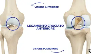 Illustrazione anatomica del ginocchio che mostra il legamento crociato anteriore. Visione anteriore e posteriore per il recupero legamento crociato anteriore senza intervento.