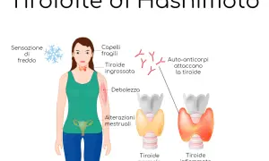 Illustrazione della tiroidite di Hashimoto: sintomi come freddo, capelli fragili, debolezza, alterazioni mestruali e auto-anticorpi che attaccano la tiroide, confrontando una tiroide normale con una infiammata.