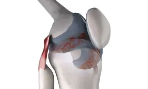 Anatomia del ginocchio con infiammazione. Scopri i rimedi naturali per il ginocchio che scricchiola.