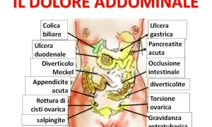 Mappa delle cause del dolore addominale: colica biliare, ulcera gastrica, appendicite acuta, torsione ovarica, ecc.