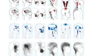 Mappa dolore riferito: illustrazioni di teste umane con aree di dolore evidenziate in rosso e blu, che mostrano la distribuzione del dolore riferito da specifici muscoli.