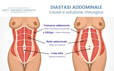 Illustrazione anatomica che mostra la diastasi addominale, evidenziando i muscoli retti e obliqui e la linea alba.