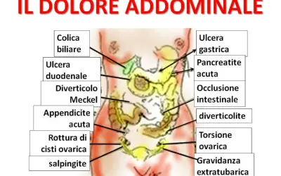 Mappa delle cause del dolore addominale: colica biliare, ulcera gastrica, appendicite acuta, torsione ovarica, ecc.