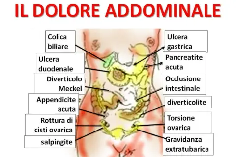 Mappa delle cause del dolore addominale: colica biliare, ulcera gastrica, appendicite acuta, torsione ovarica, ecc.