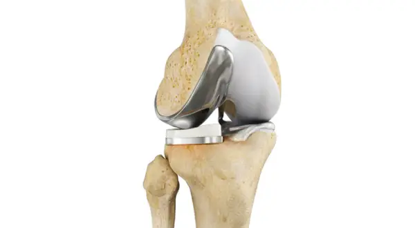 Protesi ginocchio: immagine anatomica di un ginocchio con impianto protesico. Utile per chi soffre di dolore notturno.