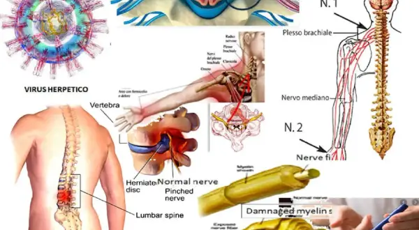 Illustrazione di compressione nervosa, virus erpetico e mielina danneggiata, con sintomi di nervo lesionato.