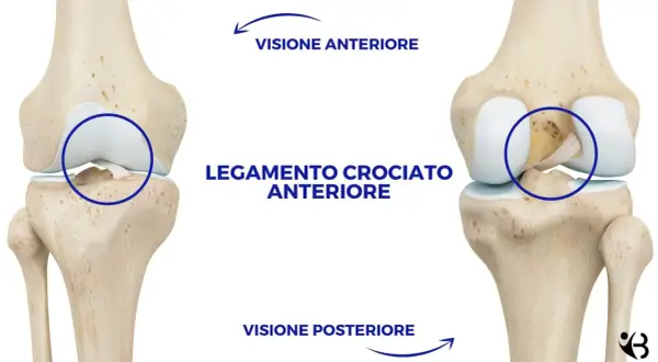 Illustrazione anatomica del ginocchio che mostra il legamento crociato anteriore. Visione anteriore e posteriore per il recupero legamento crociato anteriore senza intervento.