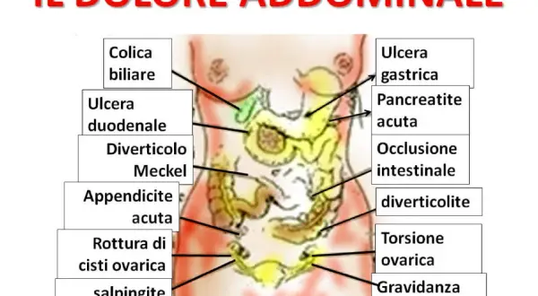 Mappa delle cause del dolore addominale: colica biliare, ulcera gastrica, appendicite acuta, torsione ovarica, ecc.