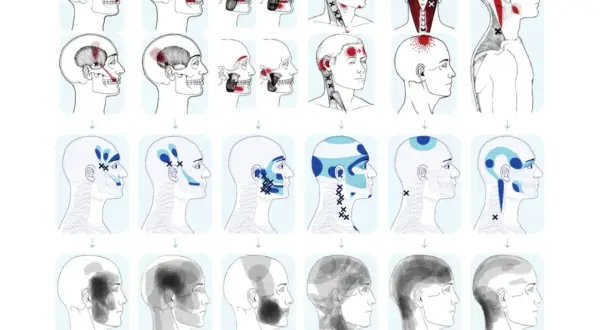 Mappa dolore riferito: illustrazioni di teste umane con aree di dolore evidenziate in rosso e blu, che mostrano la distribuzione del dolore riferito da specifici muscoli.