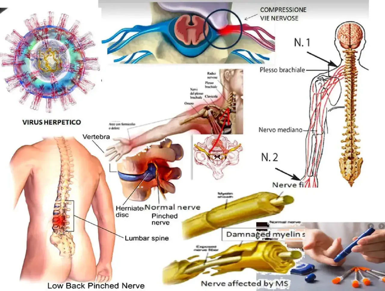 Illustrazione di compressione nervosa, virus erpetico e mielina danneggiata, con sintomi di nervo lesionato.