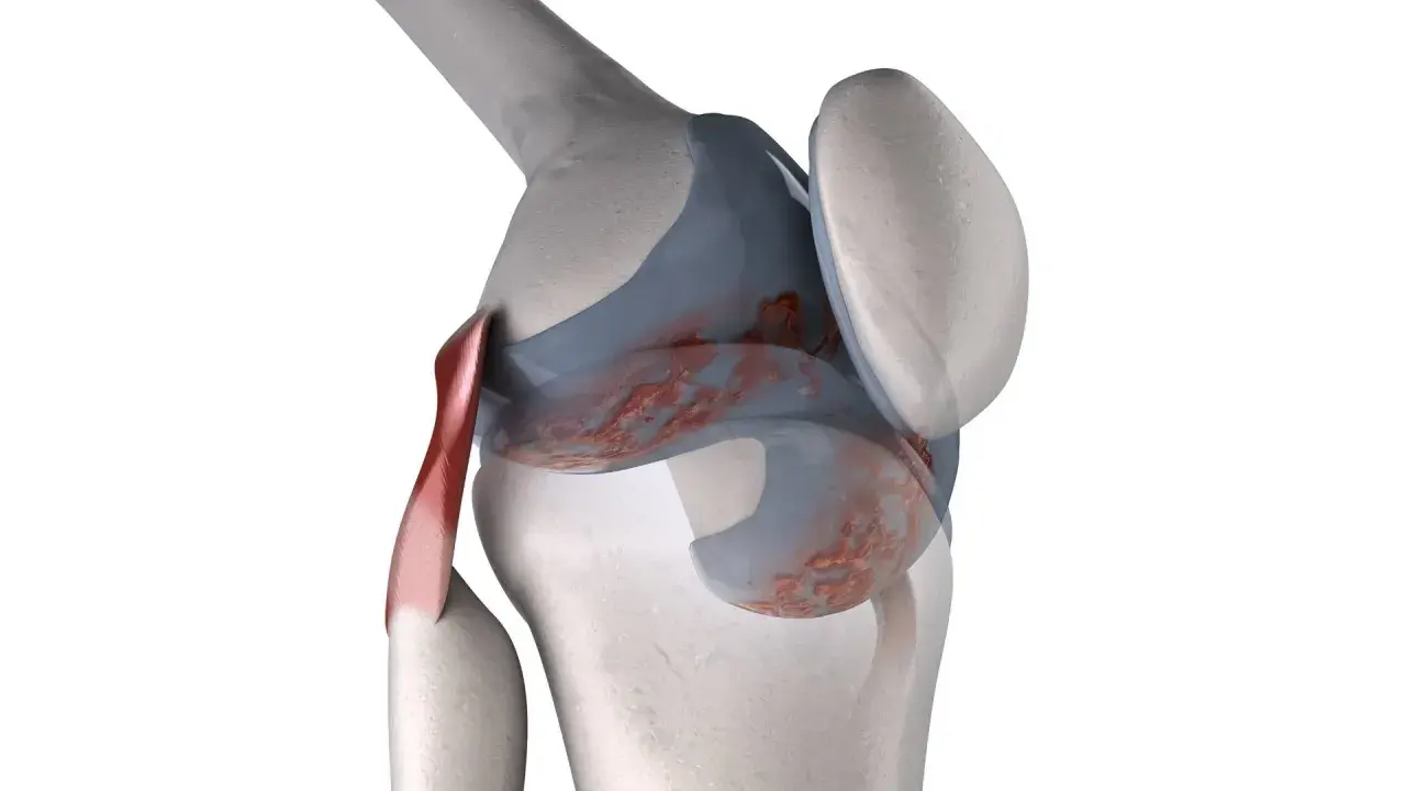 Anatomia del ginocchio con infiammazione. Scopri i rimedi naturali per il ginocchio che scricchiola.
