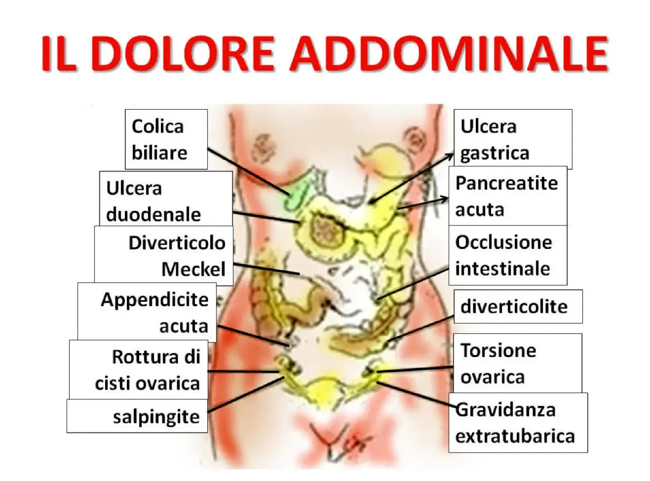Mappa delle cause del dolore addominale: colica biliare, ulcera gastrica, appendicite acuta, torsione ovarica, ecc.