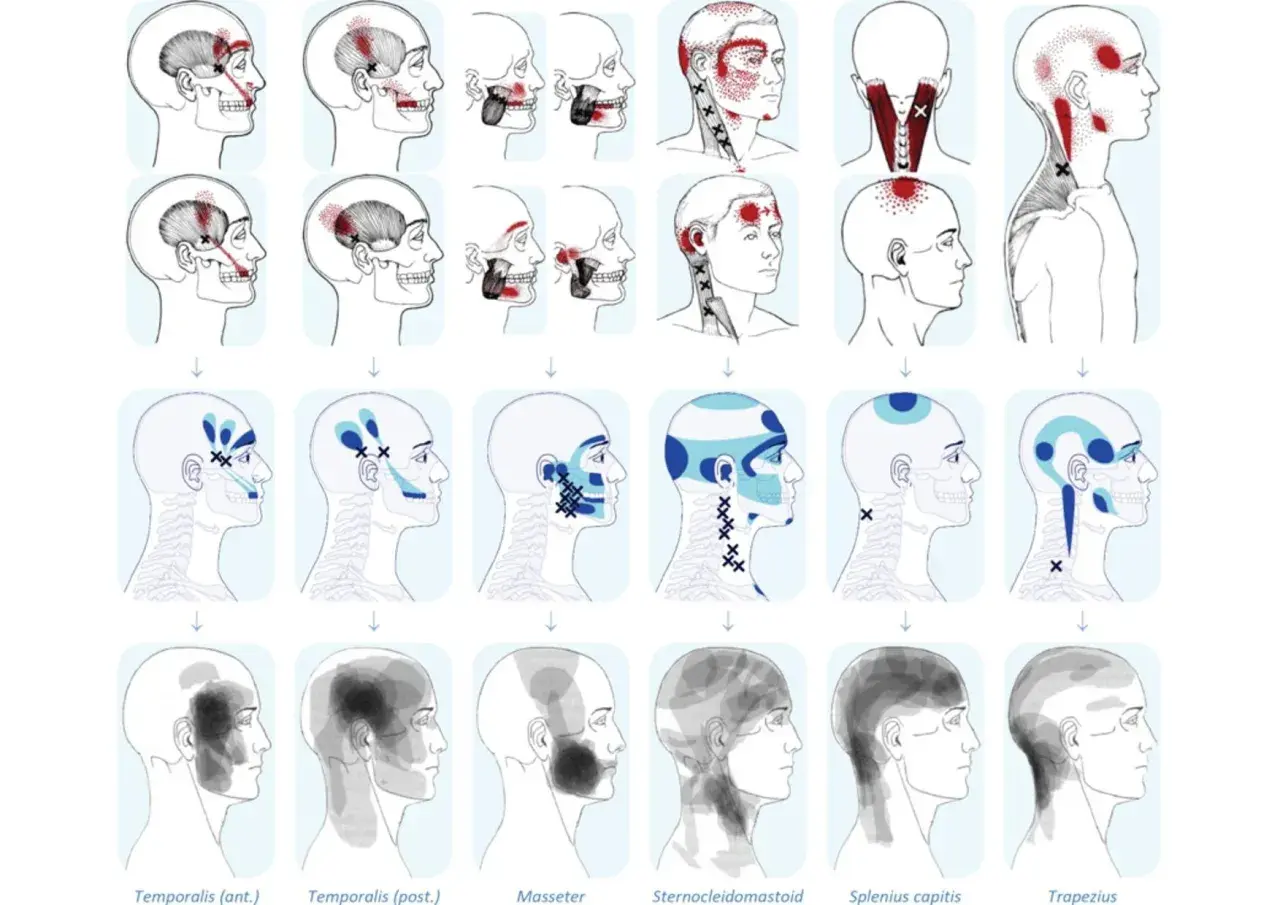 Mappa dolore riferito: illustrazioni di teste umane con aree di dolore evidenziate in rosso e blu, che mostrano la distribuzione del dolore riferito da specifici muscoli.