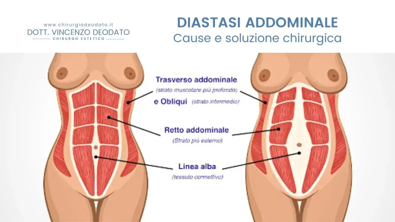 Illustrazione anatomica che mostra la diastasi addominale, evidenziando i muscoli retti e obliqui e la linea alba.