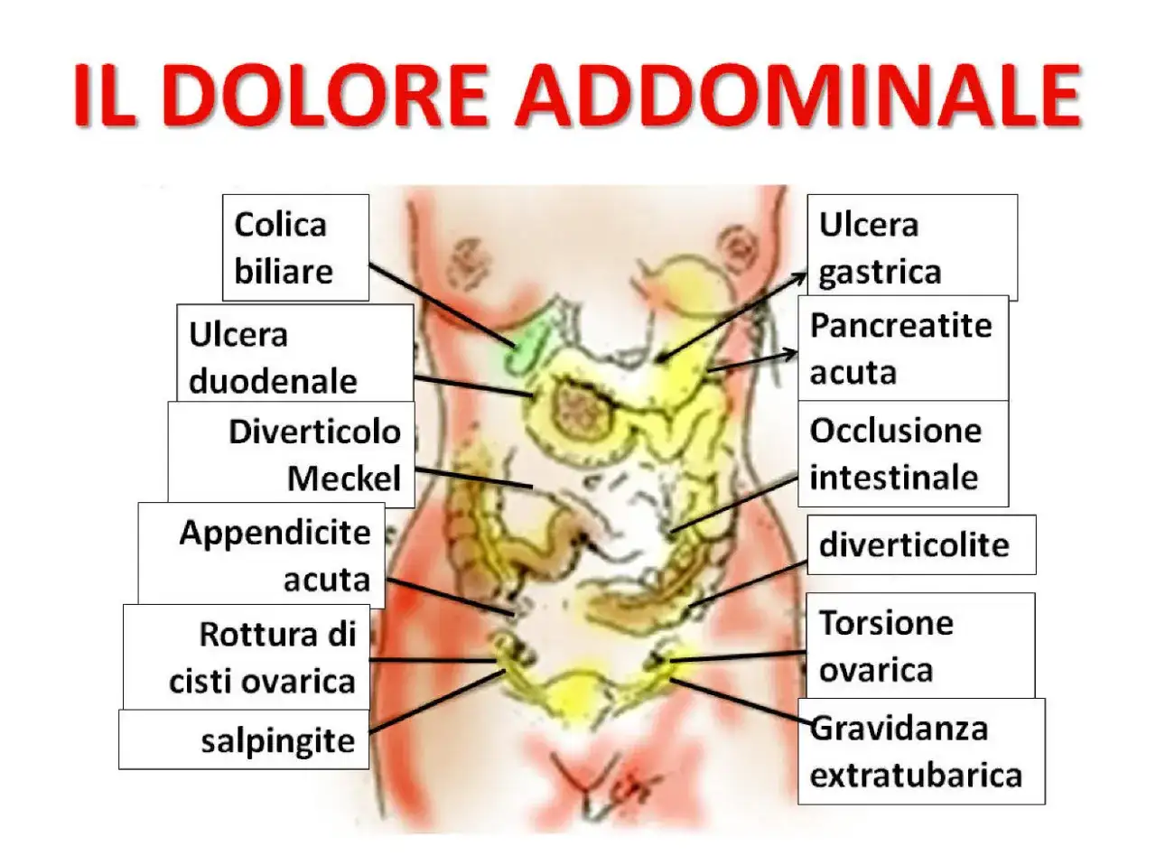 Mappa delle cause del dolore addominale: colica biliare, ulcera gastrica, appendicite acuta, torsione ovarica, ecc.
