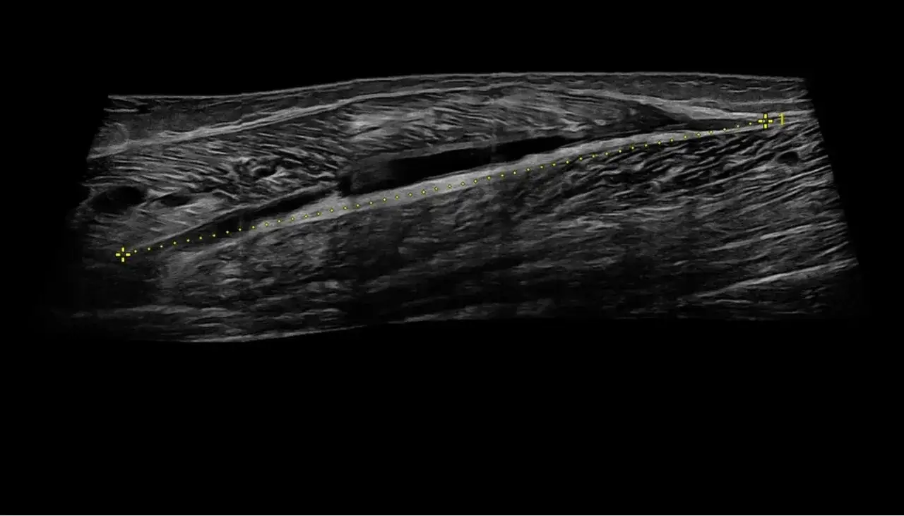 Ecografia mostra una lesione muscolare di 2 cm, con indicazione di progresso nel recupero.