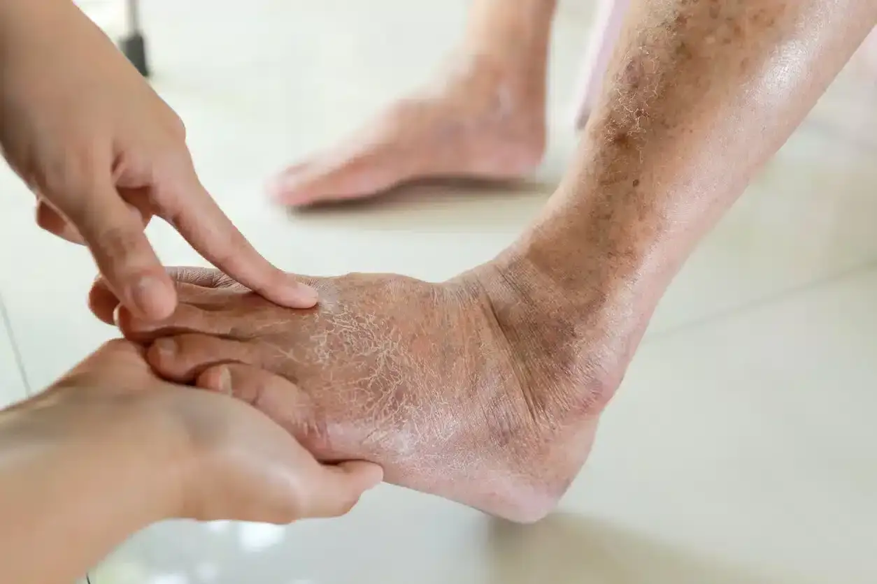 Piedi secchi e screpolati, un problema comune per chi ha sempre freddo. Scopri i rimedi per alleviare il disagio e migliorare la circolazione.