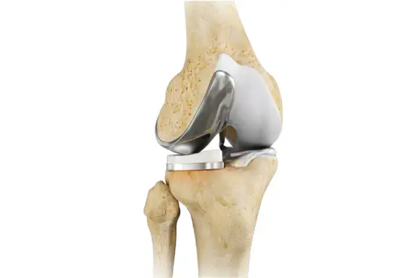 Protesi ginocchio: immagine anatomica di un ginocchio con impianto protesico. Utile per chi soffre di dolore notturno.
