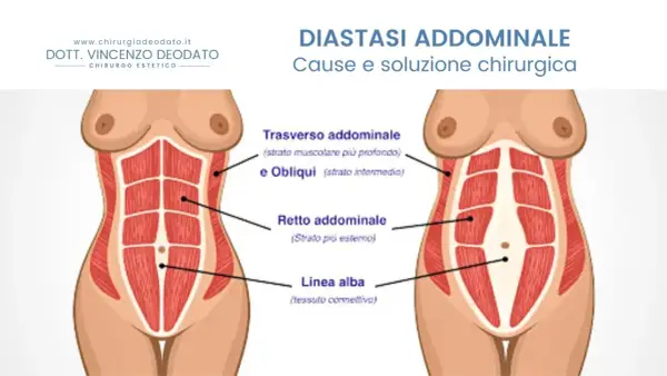 Illustrazione anatomica che mostra la diastasi addominale, evidenziando i muscoli retti e obliqui e la linea alba.