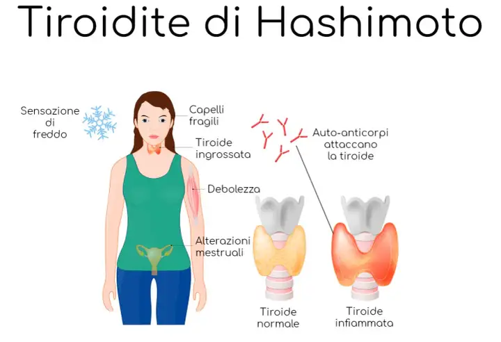 Illustrazione della tiroidite di Hashimoto: sintomi come freddo, capelli fragili, debolezza, alterazioni mestruali e auto-anticorpi che attaccano la tiroide, confrontando una tiroide normale con una infiammata.